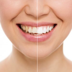 Teeth Whitening for Special Occasions: Preparing for a Big Day