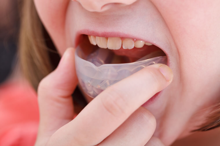 An In-Depth Look at Bruxism: Symptoms, Treatments, and Veterans’ Health Connections
