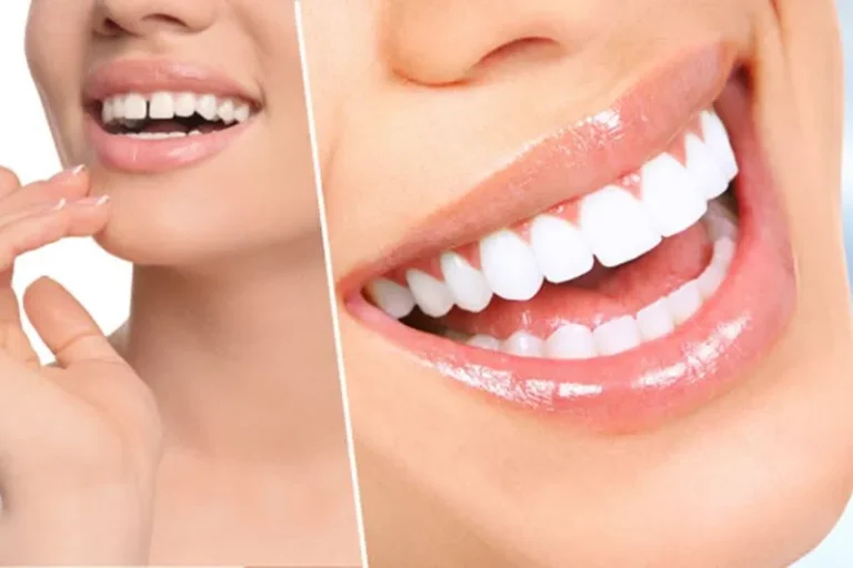 Beyond Straightness: The Complete Guide to Braces and Teeth Whitening for a Radiant Smile