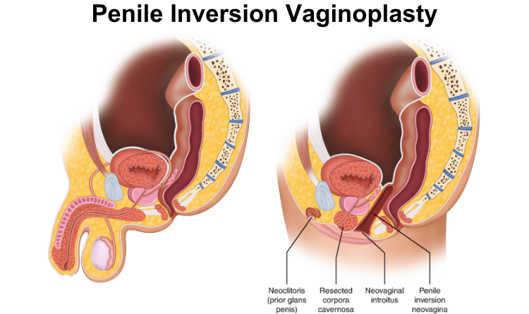 5 Things You Should Know Before Vaginoplasty In India