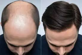 Non Surgical Hair Replacement: The Ultimate Solution for Male Hair Loss